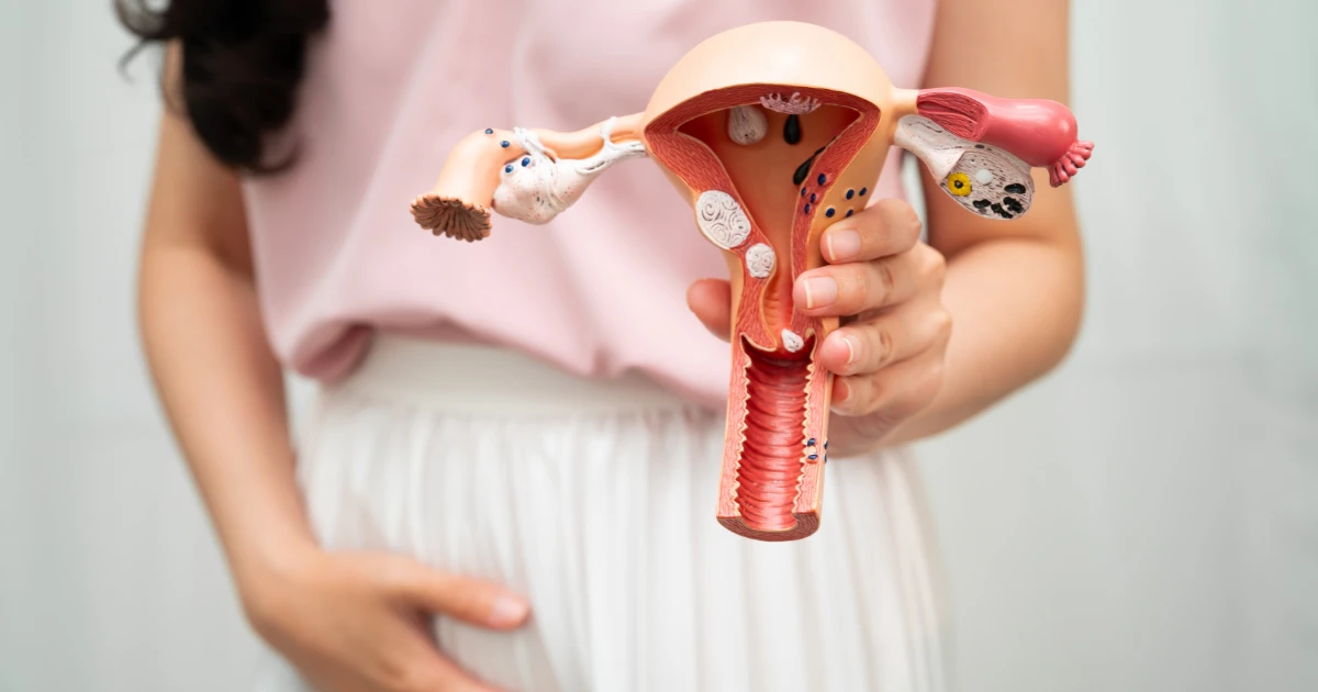 Tratamiento de miomas uterinos sin cirugía en Matagalpa